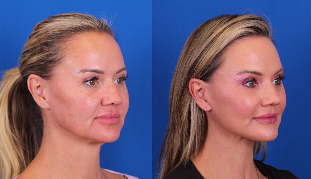 Facelift/Neck Lift Before & After Gallery - Patient 267692 - Image 2
