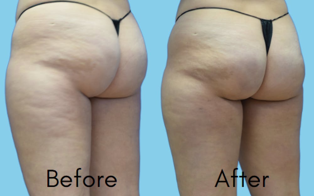Aveli Before & After Gallery - Patient 164238 - Image 2