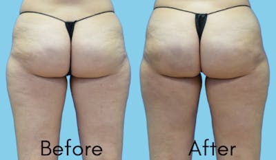 Aveli Before & After Gallery - Patient 164238 - Image 1