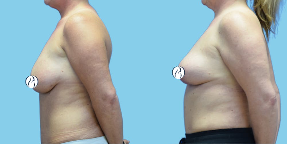 Breast Lift Before & After Gallery - Patient 300933 - Image 5