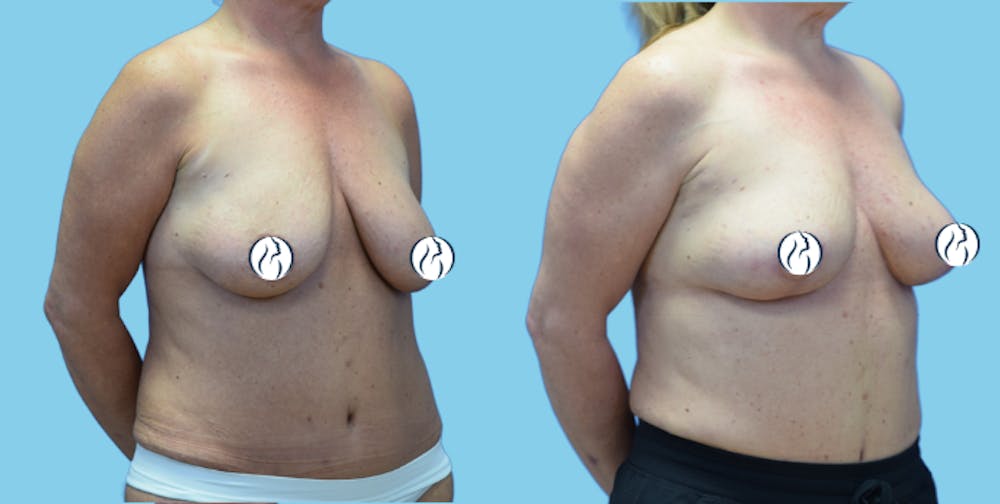 Breast Lift Before & After Gallery - Patient 300933 - Image 2