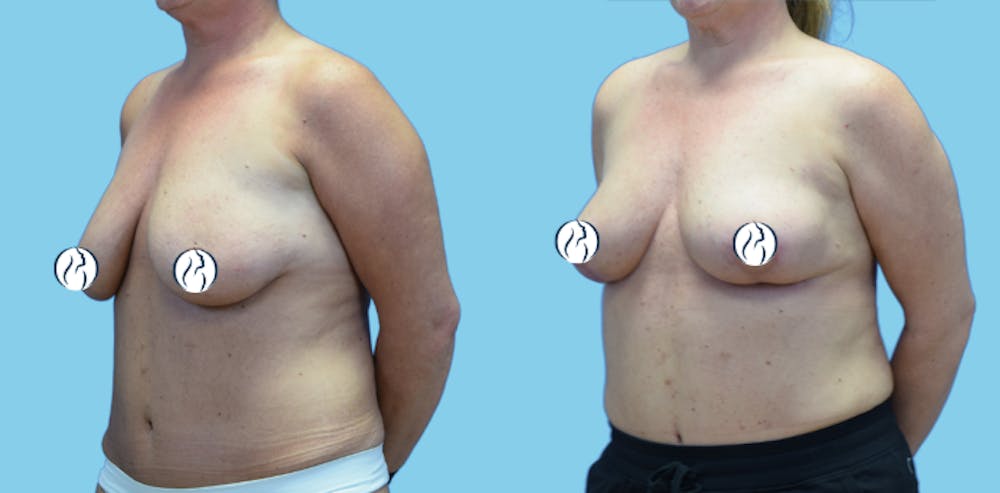 Breast Lift Before & After Gallery - Patient 300933 - Image 4