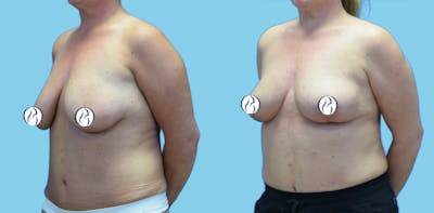 Breast Lift Before & After Gallery - Patient 300933 - Image 4
