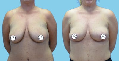 Breast Lift Before & After Gallery - Patient 300933 - Image 1