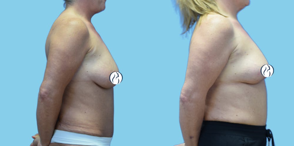 Breast Lift Before & After Gallery - Patient 300933 - Image 3