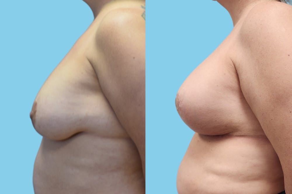 Breast Lift Before & After Gallery - Patient 200736 - Image 3