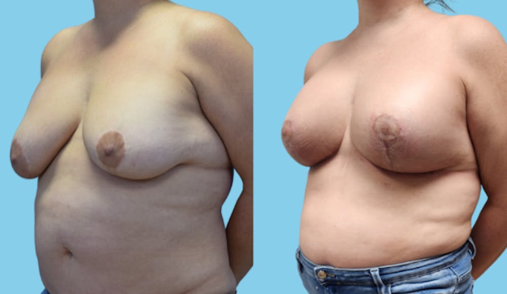 Breast Lift Before & After Gallery - Patient 200736 - Image 2