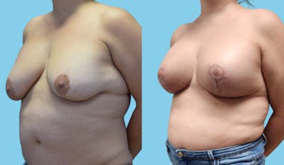 Breast Lift Before & After Gallery - Patient 200736 - Image 2