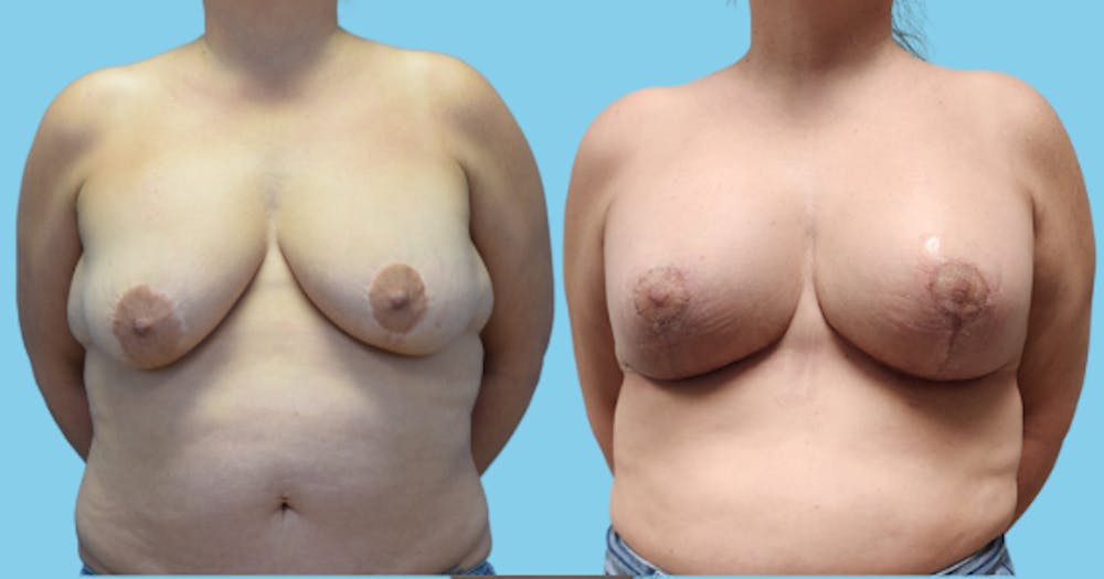 Breast Lift Before & After Gallery - Patient 200736 - Image 1