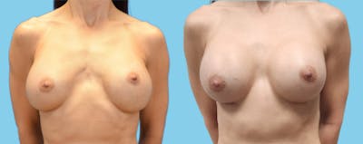 Implant Exchange Before & After Gallery - Patient 241857 - Image 1