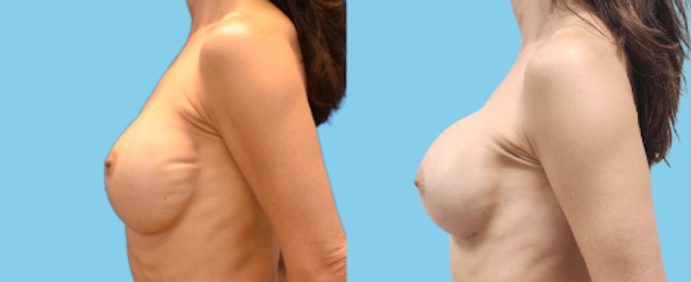 Implant Exchange Before & After Gallery - Patient 241857 - Image 2