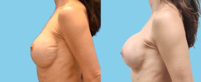 Implant Exchange Before & After Gallery - Patient 241857 - Image 2