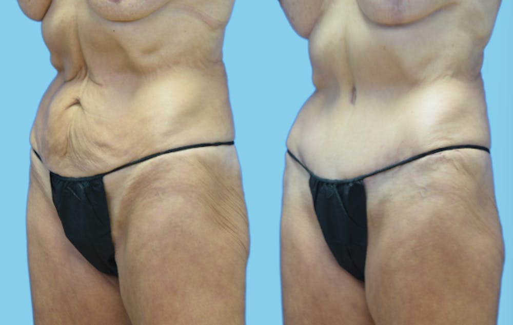 Tummy Tuck Before & After Gallery - Patient 384607 - Image 4