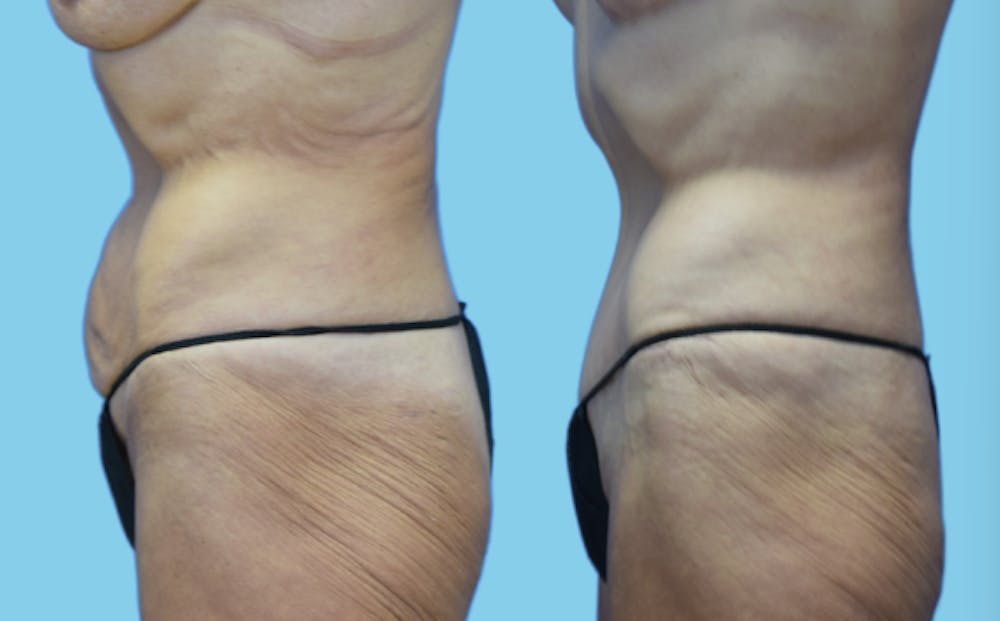 Tummy Tuck Before & After Gallery - Patient 384607 - Image 5