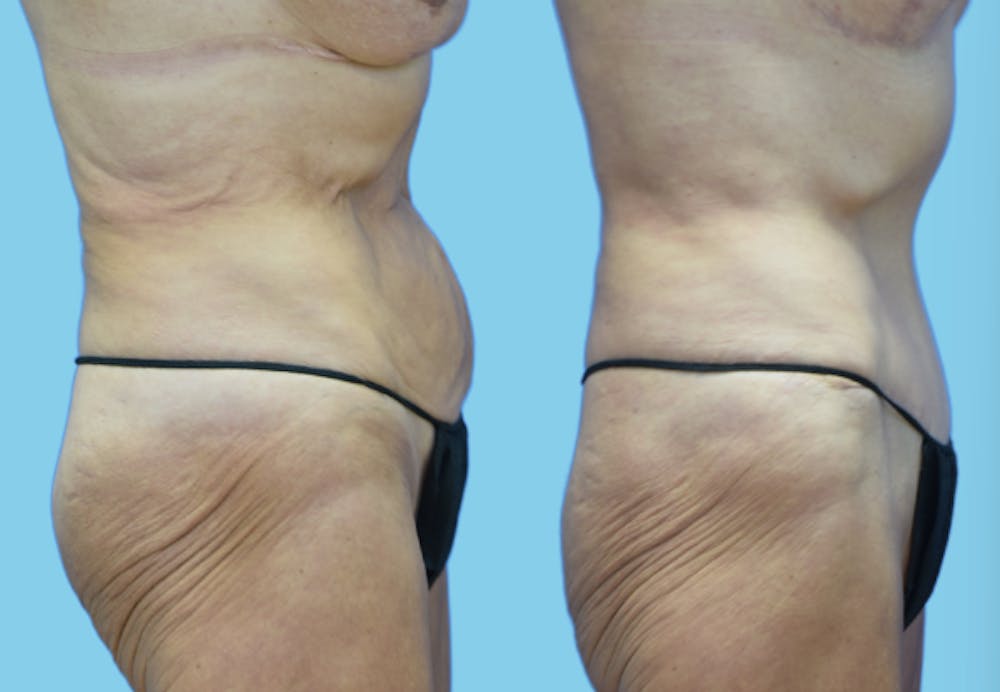 Tummy Tuck Before & After Gallery - Patient 384607 - Image 3