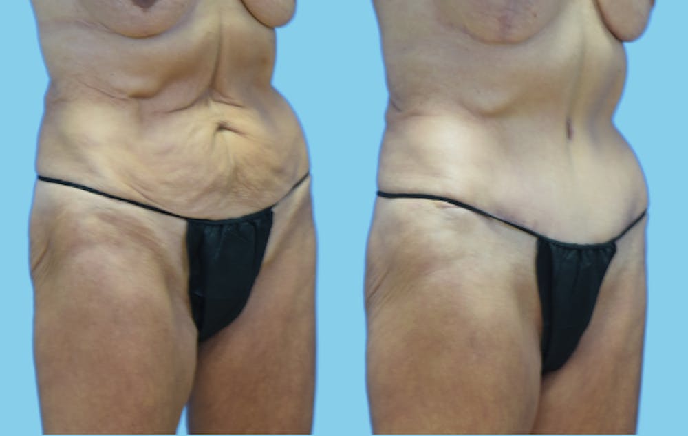 Tummy Tuck Before & After Gallery - Patient 384607 - Image 2