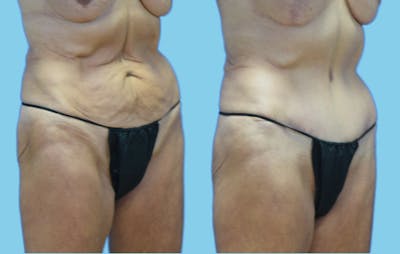Tummy Tuck Before & After Gallery - Patient 384607 - Image 2