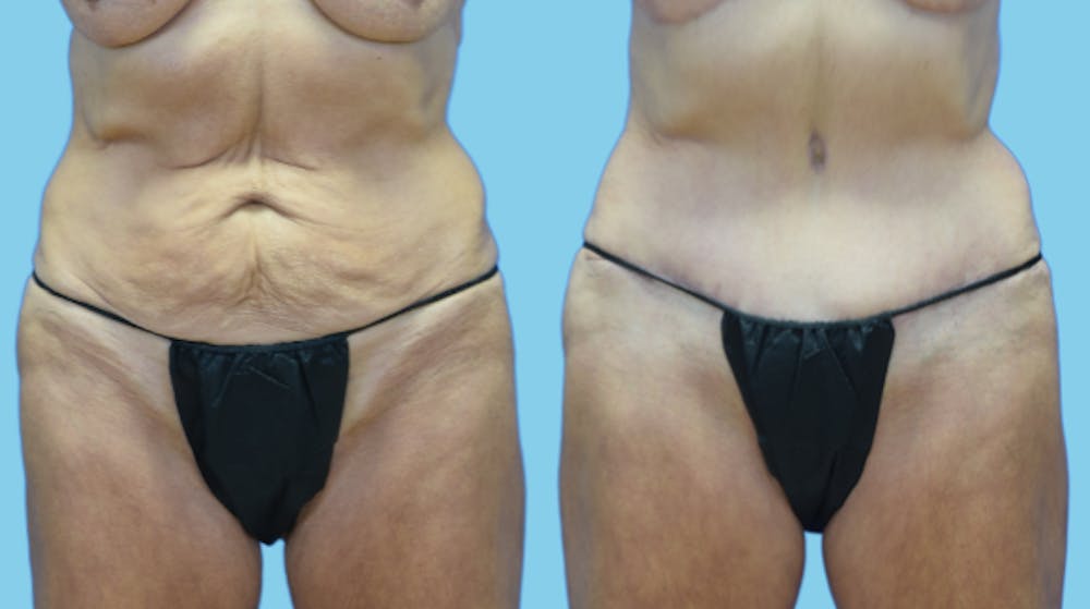 Tummy Tuck Before & After Gallery - Patient 384607 - Image 1