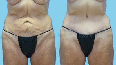 Tummy Tuck Before & After Gallery - Patient 384607 - Image 1