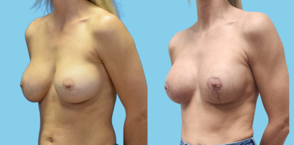 Revision Body Before & After Gallery - Patient 156661 - Image 4