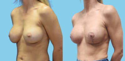 Revision Body Before & After Gallery - Patient 156661 - Image 4