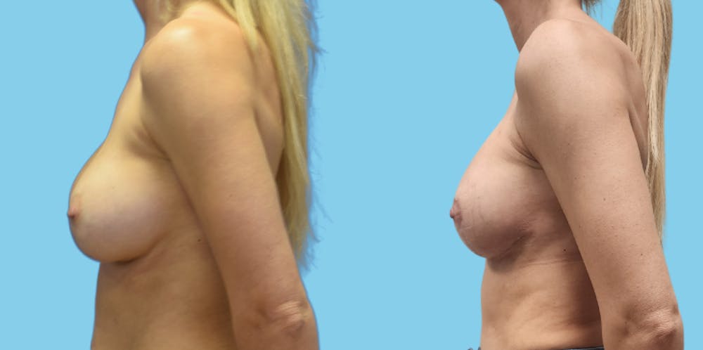 Revision Body Before & After Gallery - Patient 156661 - Image 5
