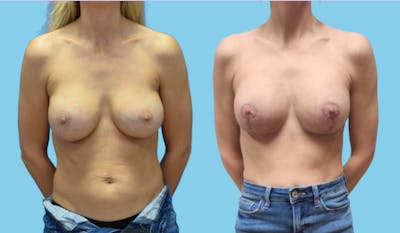 Revision Body Before & After Gallery - Patient 156661 - Image 1