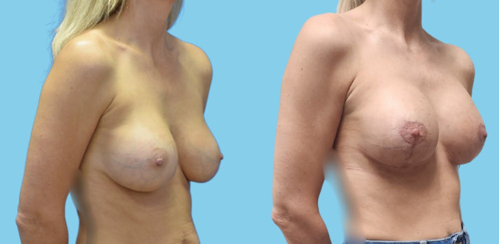 Revision Body Before & After Gallery - Patient 156661 - Image 2
