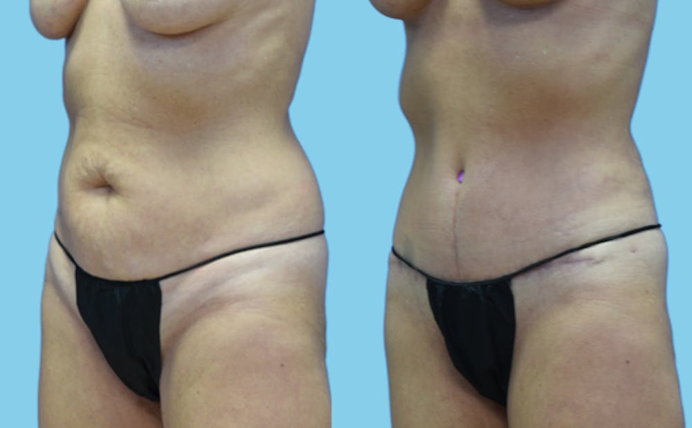 Tummy Tuck Before & After Gallery - Patient 111458 - Image 5