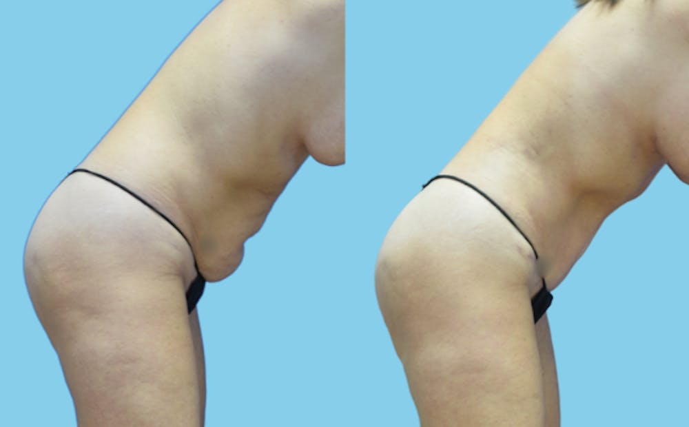 Tummy Tuck Before & After Gallery - Patient 111458 - Image 4