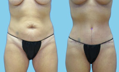 Tummy Tuck Before & After Gallery - Patient 111458 - Image 1