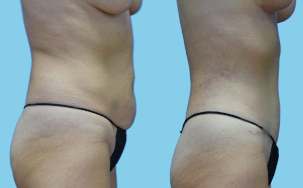 Tummy Tuck Before & After Gallery - Patient 111458 - Image 3