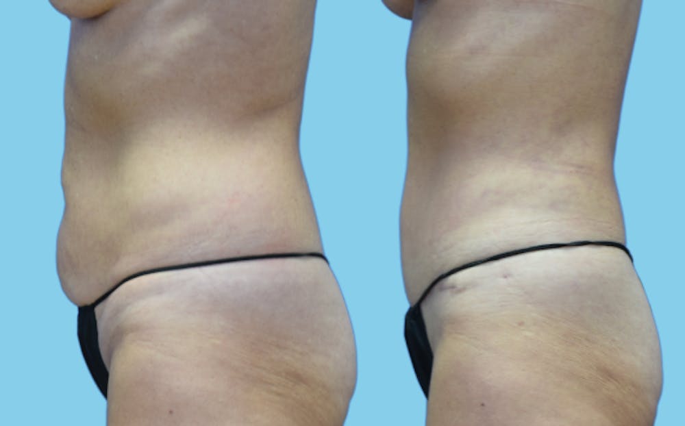 Tummy Tuck Before & After Gallery - Patient 111458 - Image 6