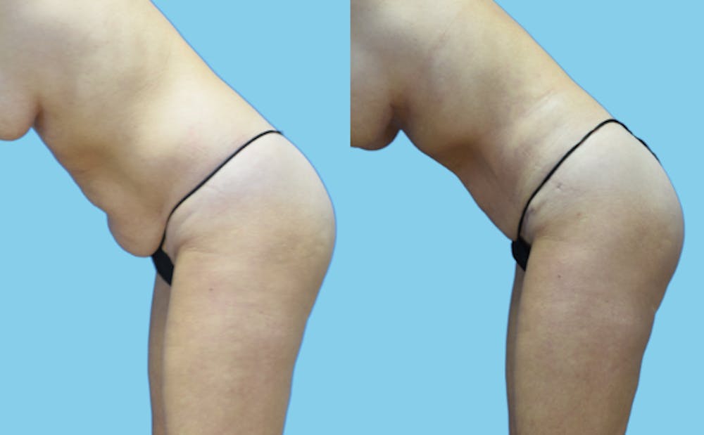 Tummy Tuck Before & After Gallery - Patient 111458 - Image 7