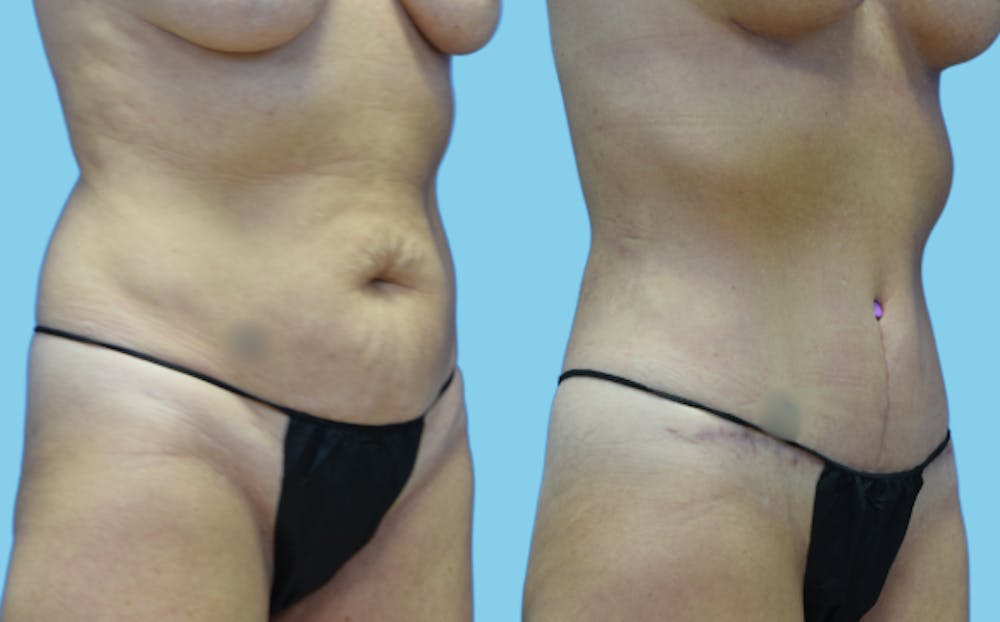 Tummy Tuck Before & After Gallery - Patient 111458 - Image 2