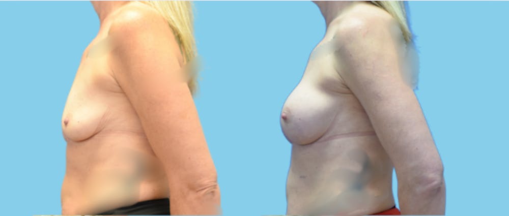 Breast Augmentation Before & After Gallery - Patient 158714 - Image 5