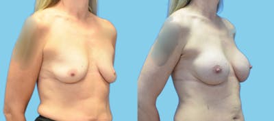 Breast Augmentation Before & After Gallery - Patient 158714 - Image 2