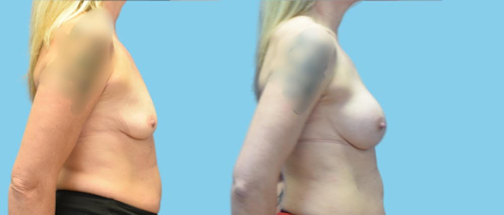 Breast Augmentation Before & After Gallery - Patient 158714 - Image 3
