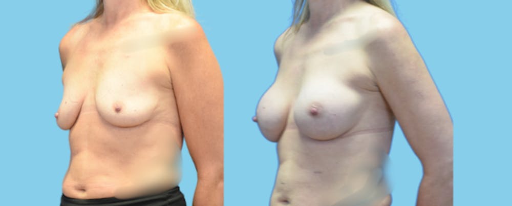 Breast Augmentation Before & After Gallery - Patient 158714 - Image 4