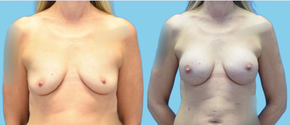 Breast Augmentation Before & After Gallery - Patient 158714 - Image 1