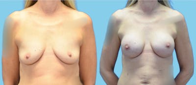 Breast Augmentation Before & After Gallery - Patient 158714 - Image 1