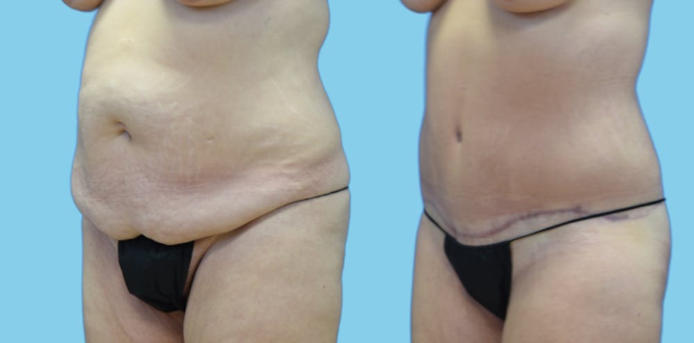 Tummy Tuck Before & After Gallery - Patient 108537 - Image 4