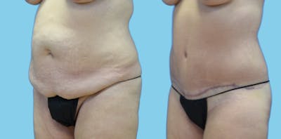 Tummy Tuck Before & After Gallery - Patient 108537 - Image 4