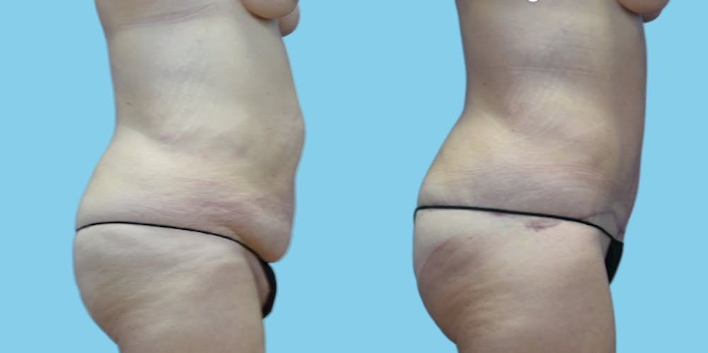 Tummy Tuck Before & After Gallery - Patient 108537 - Image 2