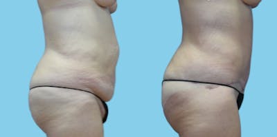 Tummy Tuck Before & After Gallery - Patient 108537 - Image 2