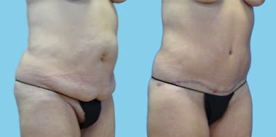 Tummy Tuck Before & After Gallery - Patient 108537 - Image 1