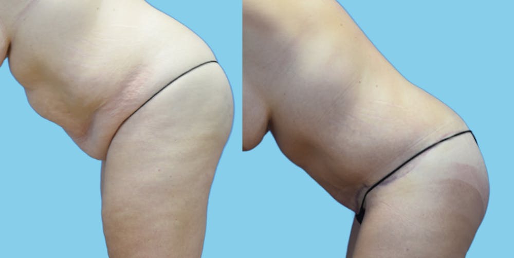 Tummy Tuck Before & After Gallery - Patient 108537 - Image 6