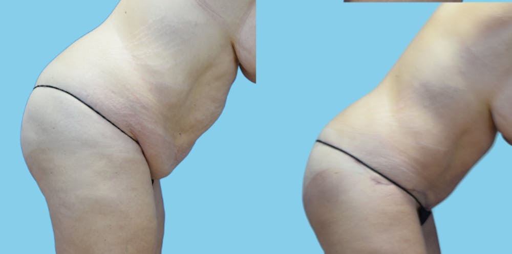 Tummy Tuck Before & After Gallery - Patient 108537 - Image 3
