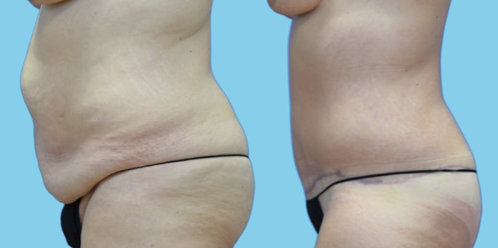 Tummy Tuck Before & After Gallery - Patient 108537 - Image 5