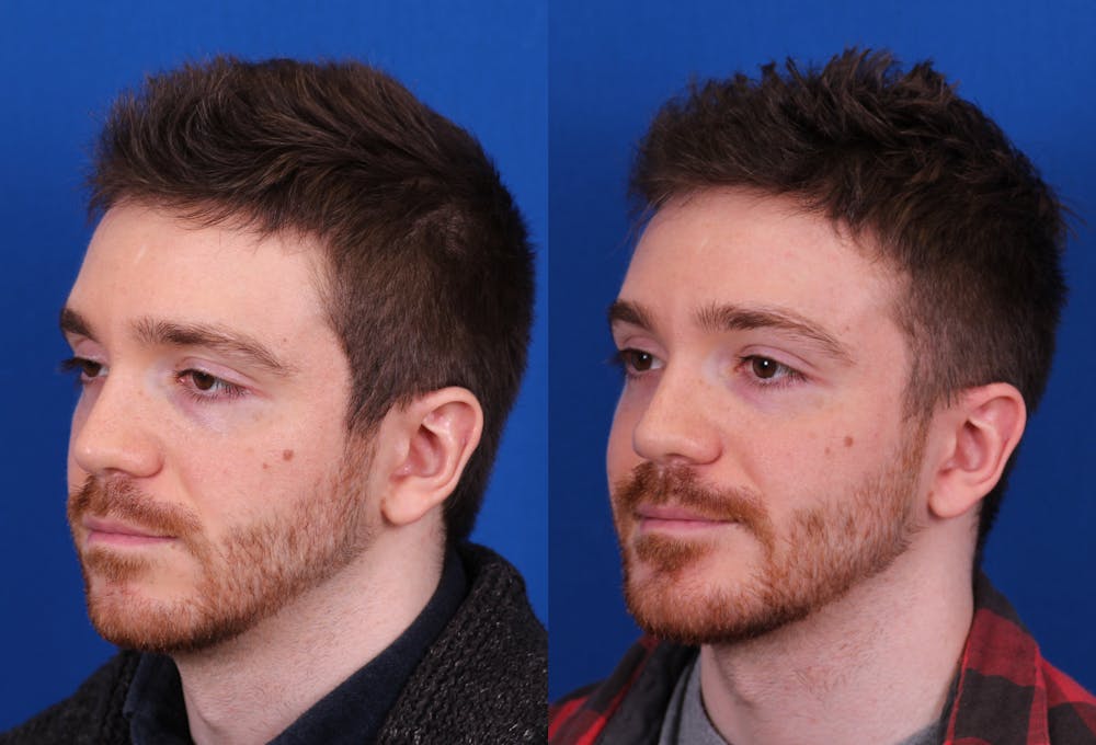 Chin Implant Before & After Gallery - Patient 297916 - Image 3
